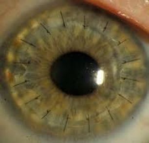 Corneal Transplant - Morris Eye Group