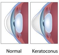Keratoconus - Morris Eye Group